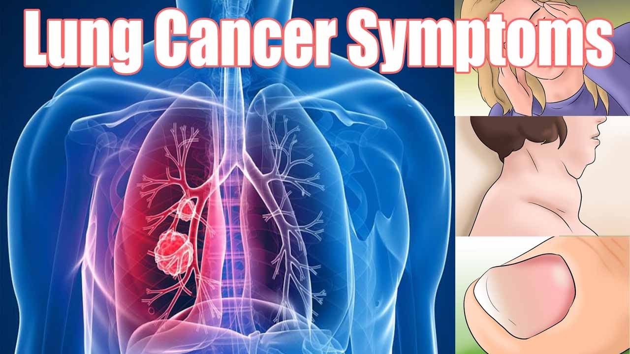 10 Symptoms Of Lung Cancer